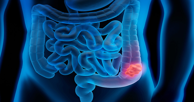 Colon Cancer