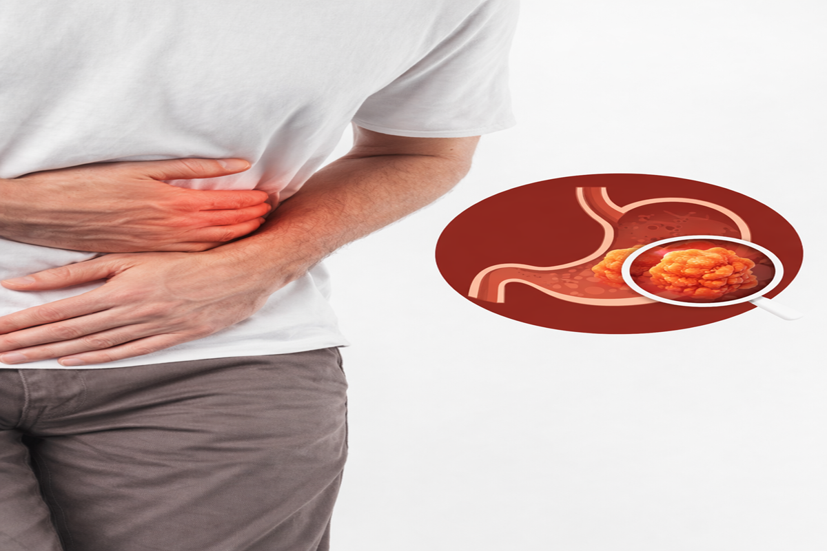 Stomach Cancer